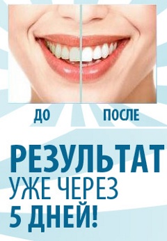 Быстрое Отбеливание Зубов - Монастыриска